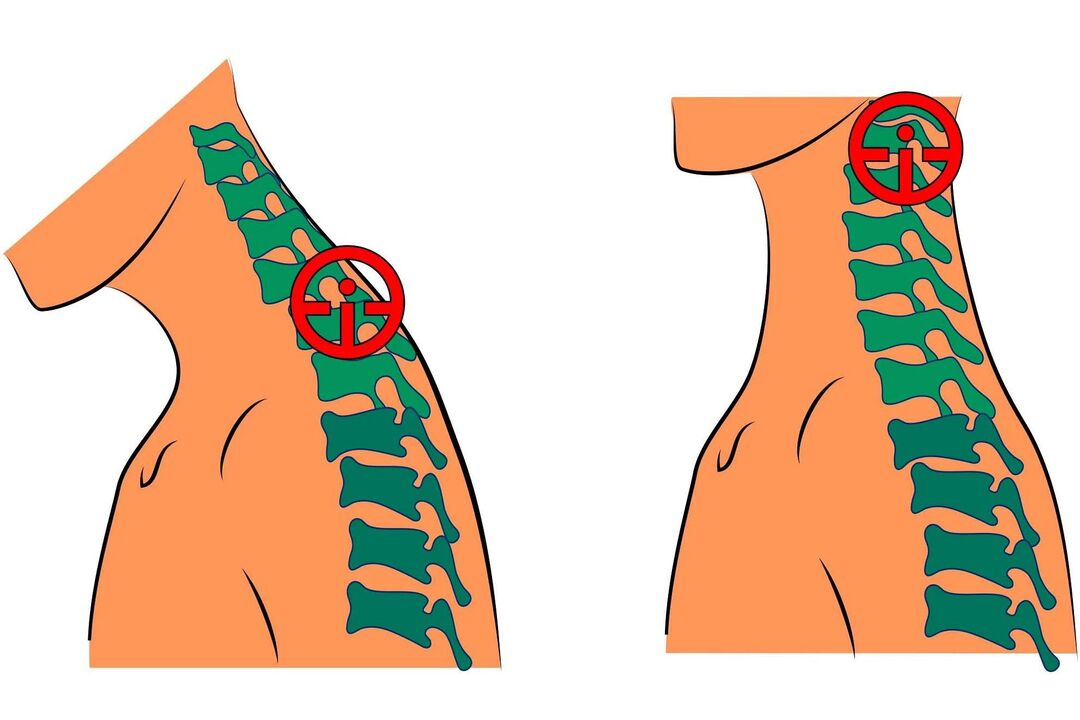 cervikalna osteohondroza