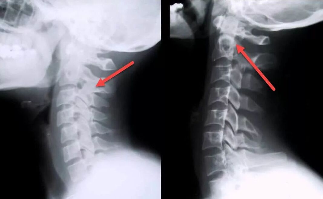 diagnoza cervikalne osteohondroze