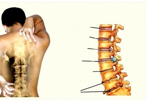 Stopnje osteohondroze materničnega vratu
