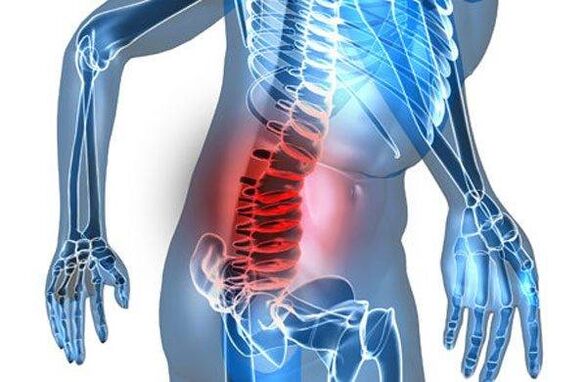 Deformacija hrbtenice v četrti fazi ledvene osteohondroze