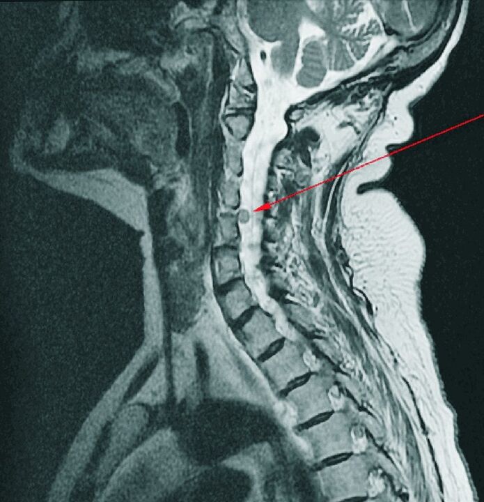 Intervertebralna kila vratne hrbtenice na MRI
