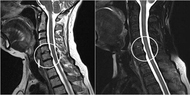 MRI vratne hrbtenice z znaki osteohondroze